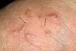 What does scabies look like?