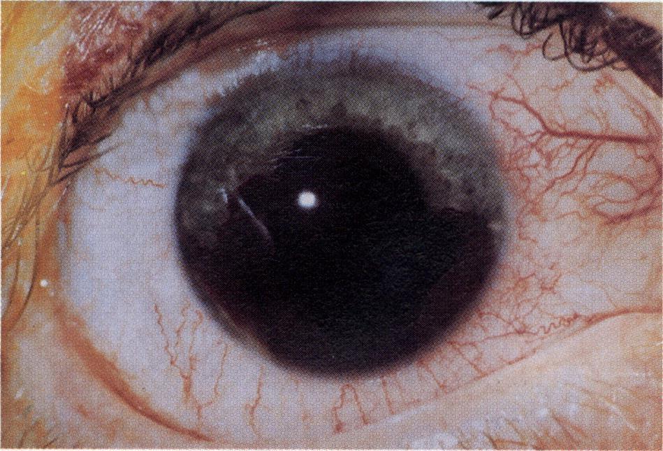Hyphema (bleeding in the anterior chamber) commonly results from blunt
