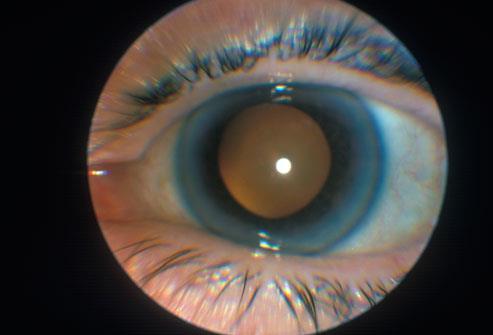 Cataracts http://www.webmd.