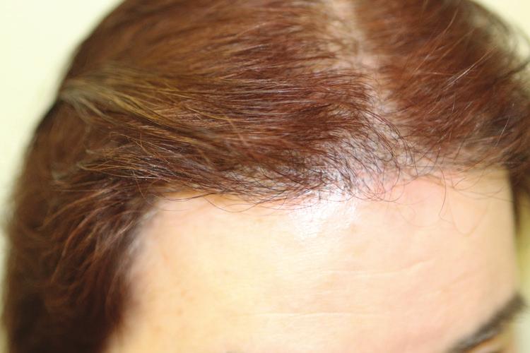 With today s popular Follicular Unit Extraction (FUE) method, grafts of live hair follicles are taken directly from the thick hair at the back and sides of the head.
