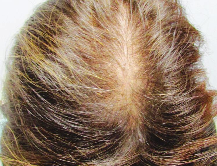 In this simple procedure, a natural biologic agent is injected into the surface of the scalp. As stem cells are activated, they stimulate the process of hair regeneration.