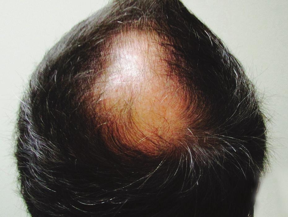 People who research options and providers tend to come back to North Atlanta Hair Restoration. Why?