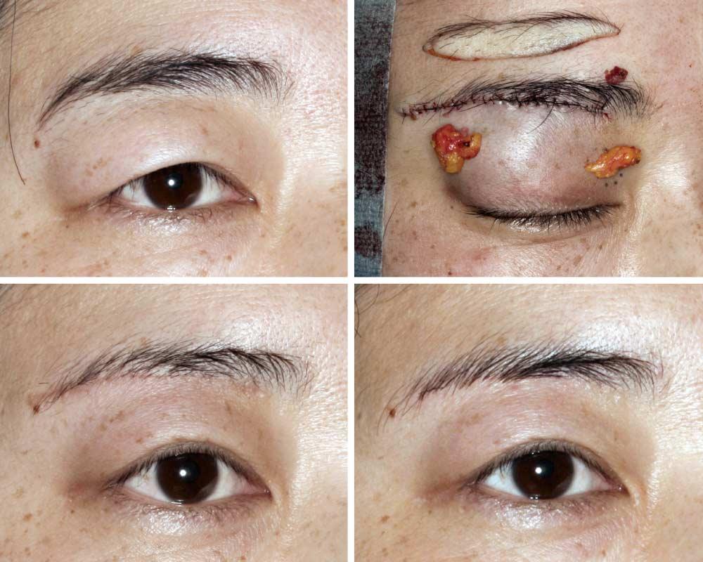 D Figure 3. A 41-year-old woman who underwent extended infrabrow excision blepharoplasty. A, Dermatochalasis with thick eyelid.