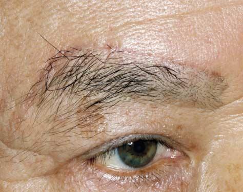 Figure 4. A 71-year-old man who underwent extended infrabrow excision blepharoplasty.