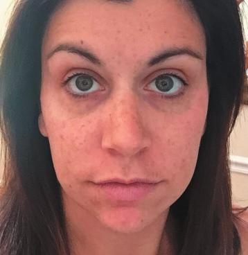 LIGHTENING REGIMEN After 8 weeks of Lightening use, participants in a clinical study noticed the following results:* PERCENT OF PARTICIPANTS HAD A REDUCTION IN: dark marks LAUREN,
