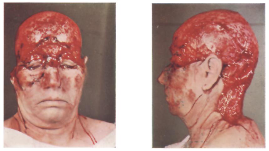 This attempt failed for reasons of a purely technical nature. A small portion of the wound was--as in the previous case--covered by small full-thickness grafts from the scalp.