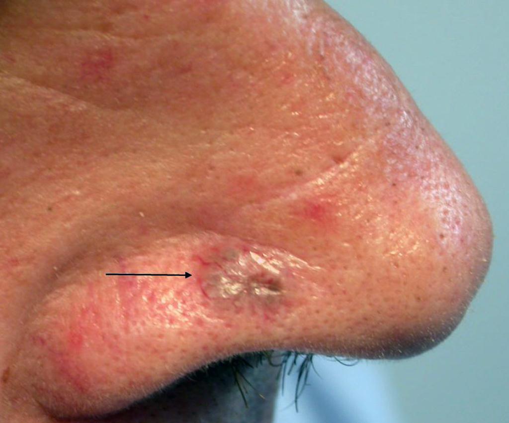 Basal Cell Carcinoma (BCC) Is the commonest type of skin cancer. A slow growing, flesh coloured lump may develop into a sore that will not heal.