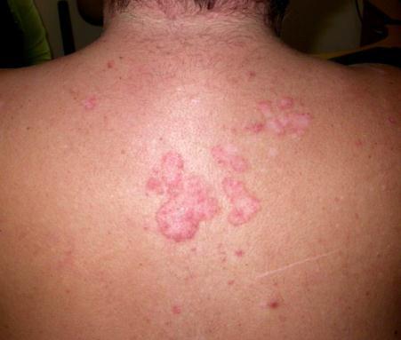 eczema, Lichen Simplex and