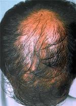 is halted, all hair grown in response to the therapy will be rapidly lost over the next 3 to 6 months. Minoxidil can complement and supplement other hair restoration treatments.