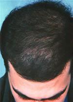 methods such as scalp reduction [Roenigk HH, Jr. Scalp reduction. In: Roenigk & Roenigk s Dermatologic Surgery, 2nd ed. New York: Marcel Dekker, Inc., 1996:1213-1226].
