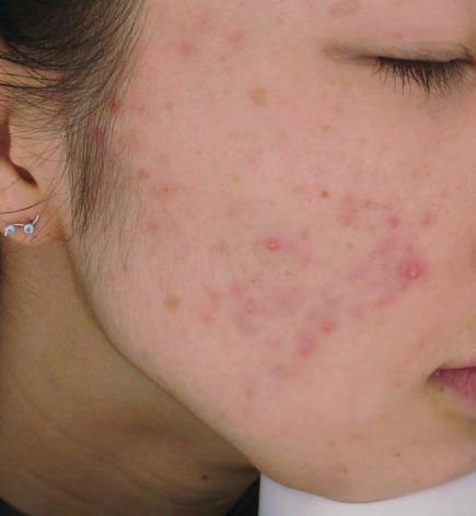 Acne Vulgaris: Burton Scale Grade 3 Skin type IV, Japanese, 23-year-old, Female Patient History Patient had been suffering from acne breakout for a year Internal, external medicine and chemical