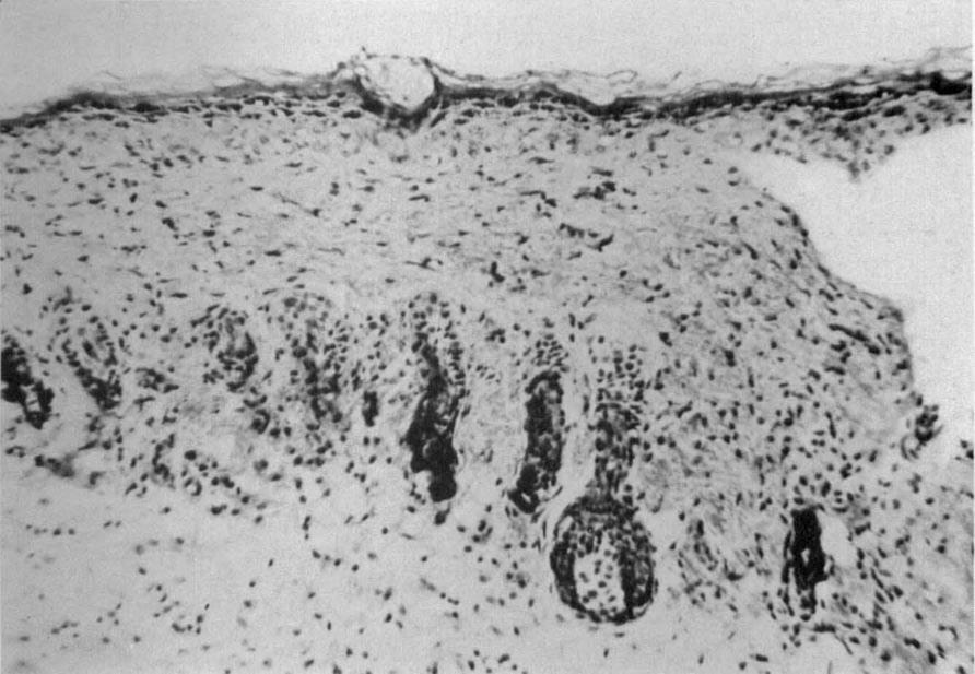 sheaths (Fig. 5). In any event, the follicles became ruptured subepidermally. The mechanism of such lysis (?) is not apparent.