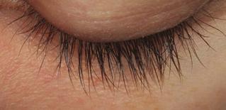 Upper Eyelid with