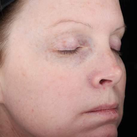 moderate discolorations, laxity, fine lines, and wrinkles (USA, 2013).