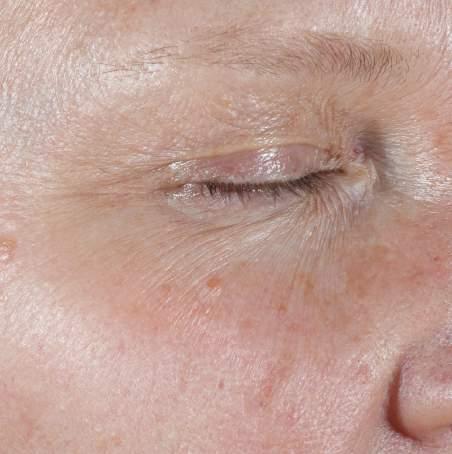 CLINICAL RESULTS: C E FERULIC 12 WEEKS C E FERULIC REDUCTION IN FINE LINES AROUND THE EYE AREA 16-week clinical study conducted on 50 Caucasian male and female subjects ages 40-60 years old