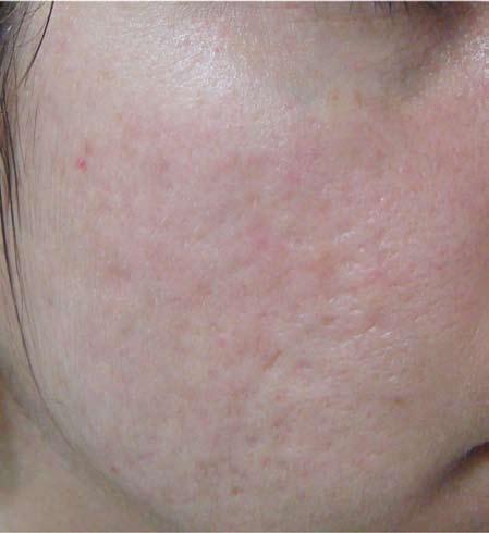 Acne Scars After 3 Tx.