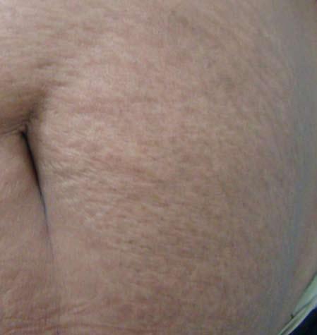 Stretch Marks After Courtesy of: Maria Claudia Issa, MD & PhD in Dermatology, Rio de Janeiro,
