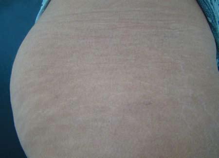 Stretch Marks After 4 Tx Courtesy of: Maria