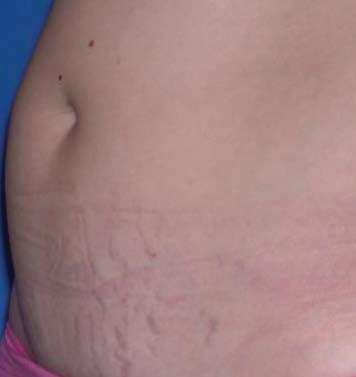 Stretch Marks After 1 Tx Courtesy of: Dr.