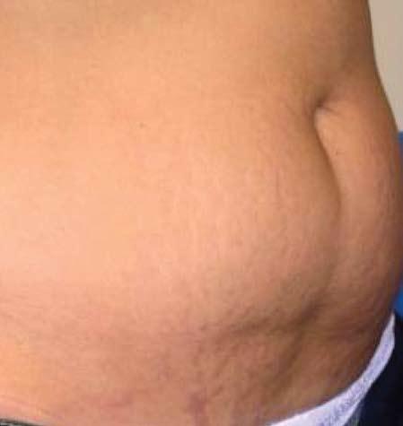 Stretch Marks After 3 Tx Courtesy of: