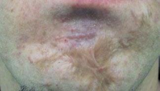 Scars After 1 Tx Courtesy of: Tania Meneghel,