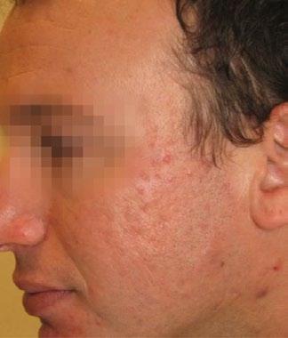 Acne Scars After 3 Tx Courtesy of: Michael Shohat,
