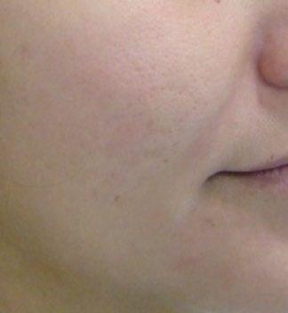 Acne Scars After 1 Tx Courtesy of: Maria Claudia