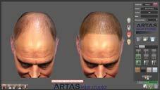 options while showing you various graft counts and hair