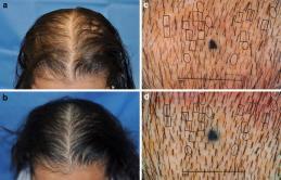 Slide 40 Hair Regrowth Efficacy and Safety of a Low-level Laser Device in the Treatment of Male and Female Patter n Hair Loss: A Multicenter, Randomized, Sham Device -controlled, Double-blind Study-