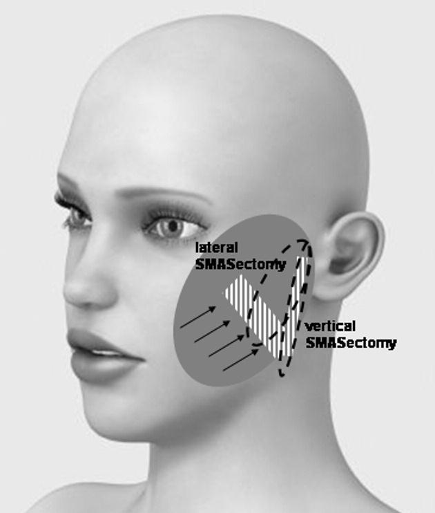 Figure 2 The extent of flap undermining (grey area) and SMAS excisions. Flap dissection is in the subcutaneous plane and avoids injury to the facial nerve.