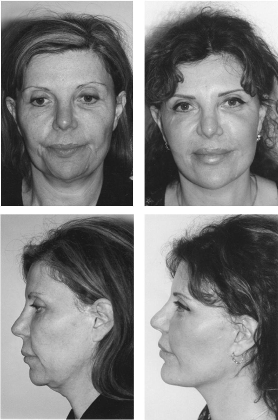 Figure 4 Full face and lateral views of a patient before (left panels) and 12 months after (right) the S-Plus lift.