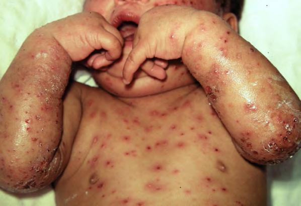 What to do if the chicken pox gets worse Go to the doctor if any of these things happen: spots get redder, warm or painful your child gets a fever, cough, diarrhoea (you say, dy-a-ree-a) or starts