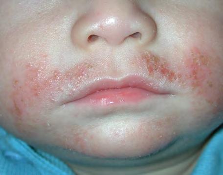 Eczema (you say, ex ma) Eczema is also known as dermatitis (you say, der-ma-ty-tis). Eczema is not an infection. Your child cannot give eczema to another child.