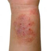 What to do if eczema gets infected These are pictures of infected eczema.