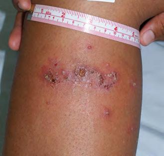 Impetigo (you say, im-pa-ty-go), also known as school sores Blisters on exposed parts of body, such as hands, legs and face.