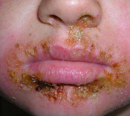 What to do if impetigo gets worse You need to go back to the doctor if any of these things happen: sores last more than a week sores become red or swollen sores have pus in them your child has a