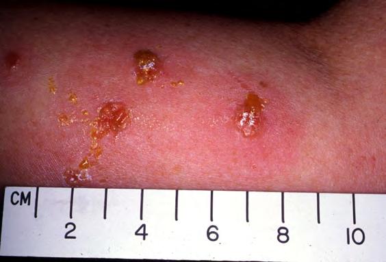 What to do if ringworm gets worse Go to the doctor if any of these things happen: the infection lasts more than 2 weeks the ringworm is on the scalp skin becomes red and swollen there is some pus in