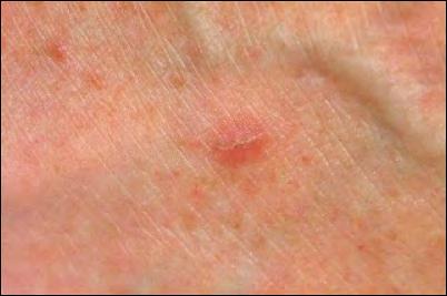 Scabies (you say, skay-bees) Scabies is caused by a tiny insect known as a mite which digs under the skin and lays eggs. Small blisters grow on the skin above each egg and the skin gets very itchy.