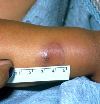 Cellulitis (you say, sell-you-ly-tis) Any area of skin can become infected with cellulitis if the skin is broken, for example from a sore, insect bite, boil, rash, cut, burn or graze.