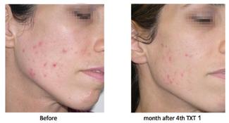 combine a non-ablative laser with simultaneous contact cooling and vacuum technology to treat acne vulgaris safely and effectively.