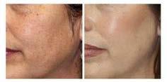 instantly younger 87% Dramatically improves skin