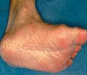 may also spread to the bottoms of the feet, the instep, between the toes and toenails.