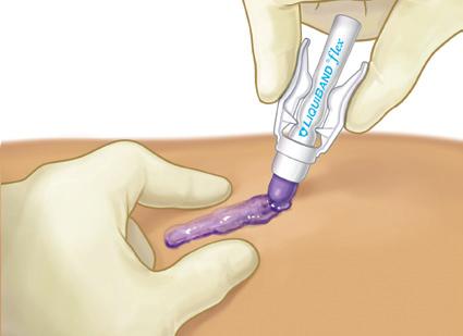 STEP THREE: After cracking the ampoule, tilt the tip of the applicator downward Give the wings a few gentle pumps until the applicator tip turns violet The device is now ready to use STEP SIX: