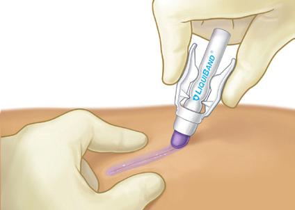 the flow of glue * If using on the eye area, adjust the patient s position. Use petroleum jelly to create a barrier close to the wound, and use surgical gauze to protect patient s eyes.