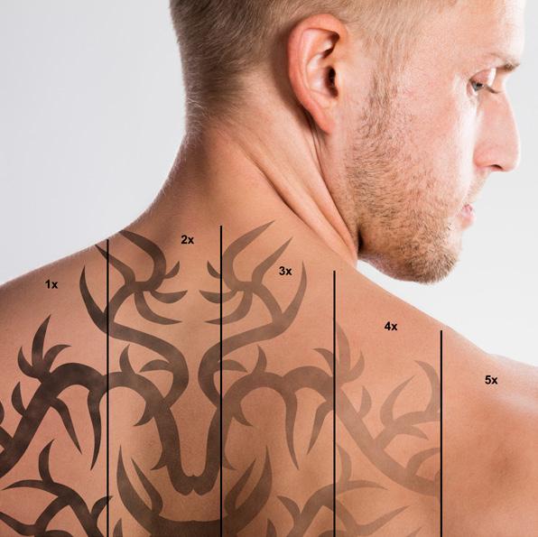 The laser tattoo removal industry is growing rapidly at present with too few practitioners available to attend to the demand. This skill will set you apart from other cosmetic practitioners.