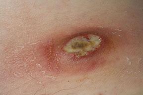 Furoncle=boil as A area boil of iscollects a most skin infection, infection under and that a skin. tender starts lump inboils aeyelid, hair develops.