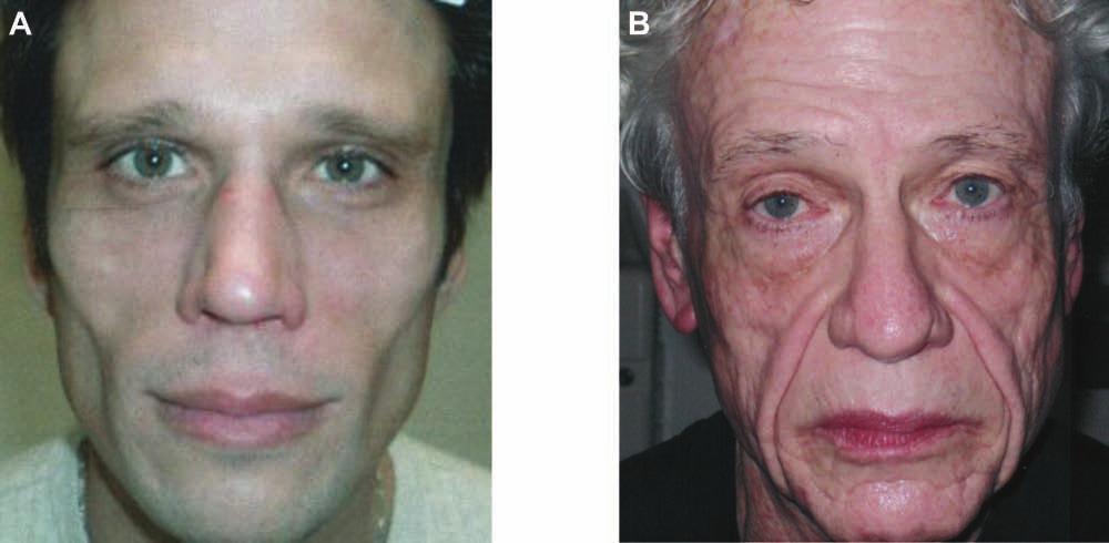 20S Aesthetic Surgery Journal 30(Suppl 1) Figure 13. (A) This 28-year-old woman presented for subtle feminization of her facial shape. (B) Four months posttreatment.