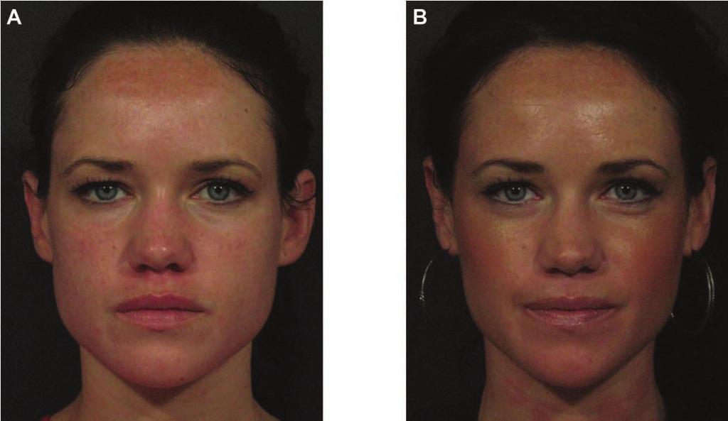 Photos courtesy of Rebecca Fitzgerald, MD. Reprinted with permission from Jones DH. Injectable Fillers: Principles and Practice. Wiley-Blackwell, London 2010. Figure 14.