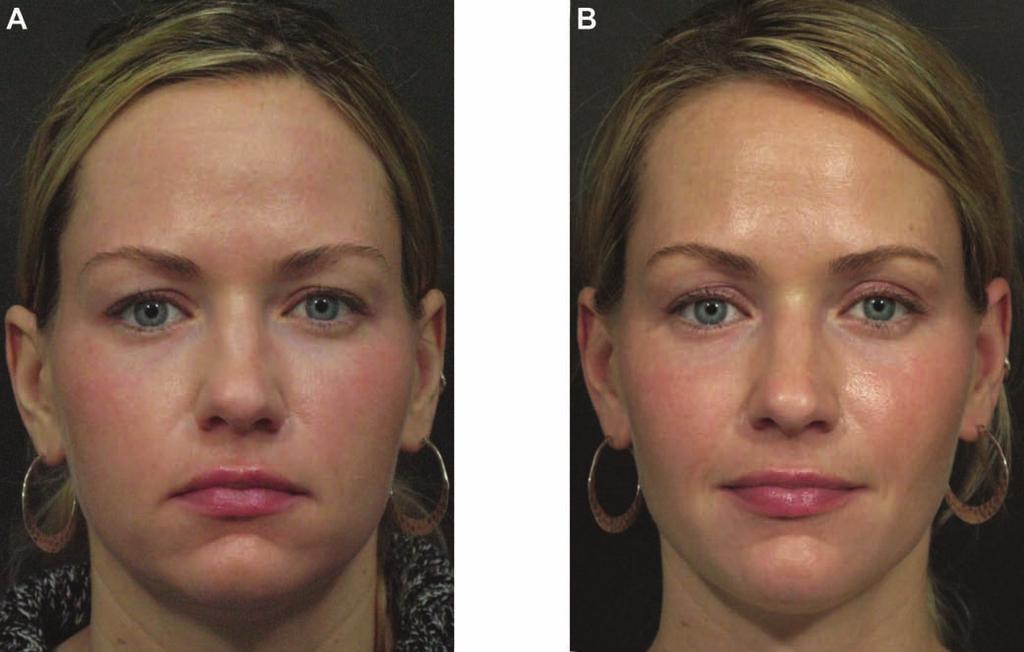 Fitzgerald et al 21S Figure 15. (A) This 30-year-old, baby-faced woman presented with poor craniofacial support. (B) Four months after her final treatment.