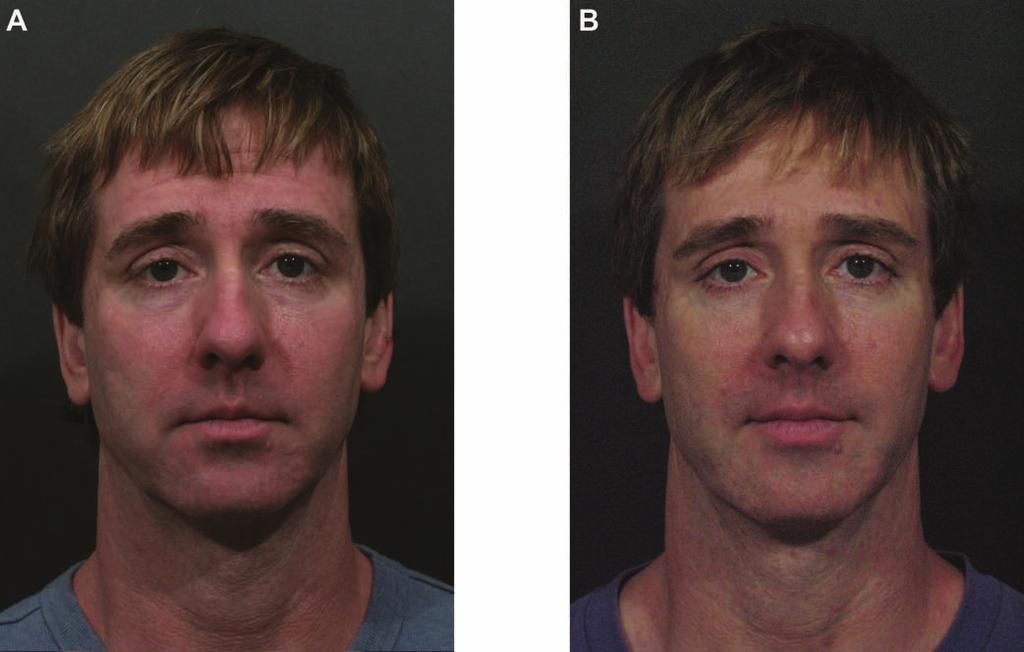 22S Aesthetic Surgery Journal 30(Suppl 1) Figure 16. (A) This 50-year-old man presented for treatment of a tired appearance. (B) One year after final treatment.